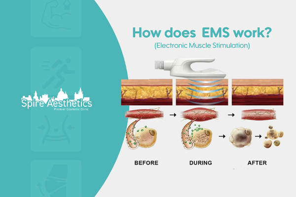EMS treatment for post pregnancy weight loss treatment Blackburn