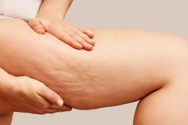 Image of woman showing leg with cellulite Blackburn