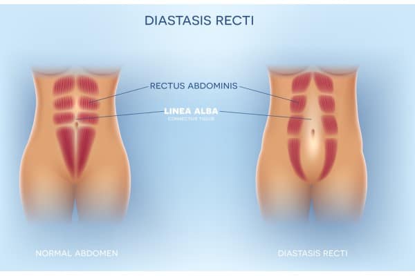 What Non-Surgical Options Are Available for Diastasis Recti Blackburn?