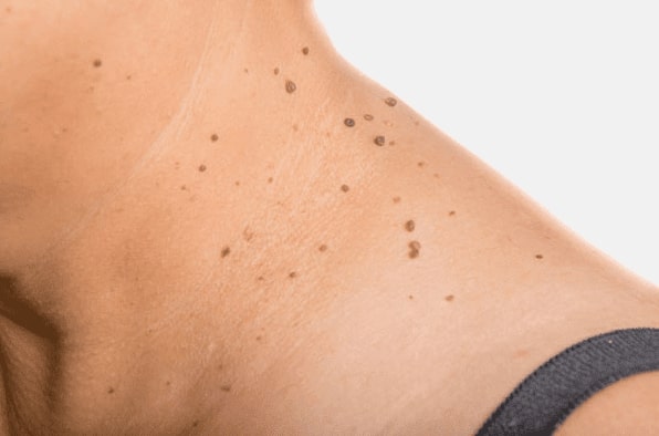 Are you looking for easy skin tag removal Blackburn - then contact Spire today!