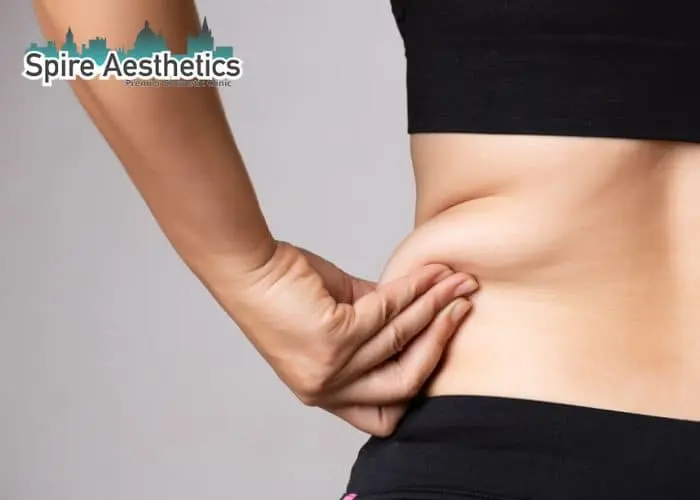 Image of woman pinching fat on their hips Blackburn. Fat Freezing treatment