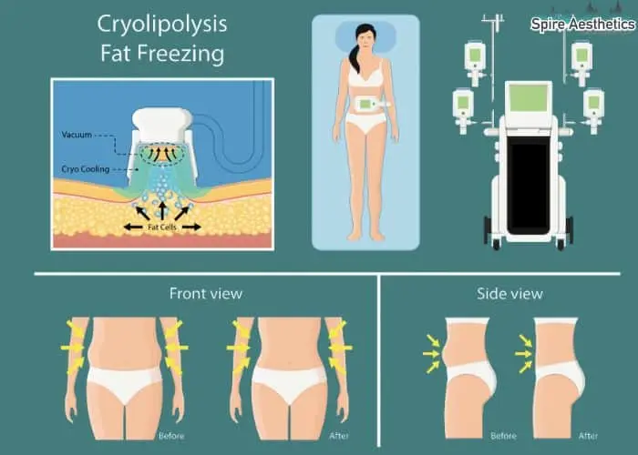 Fat freezing treatment Blackburn benefits for competitions to remove stubborn fat deposits.
