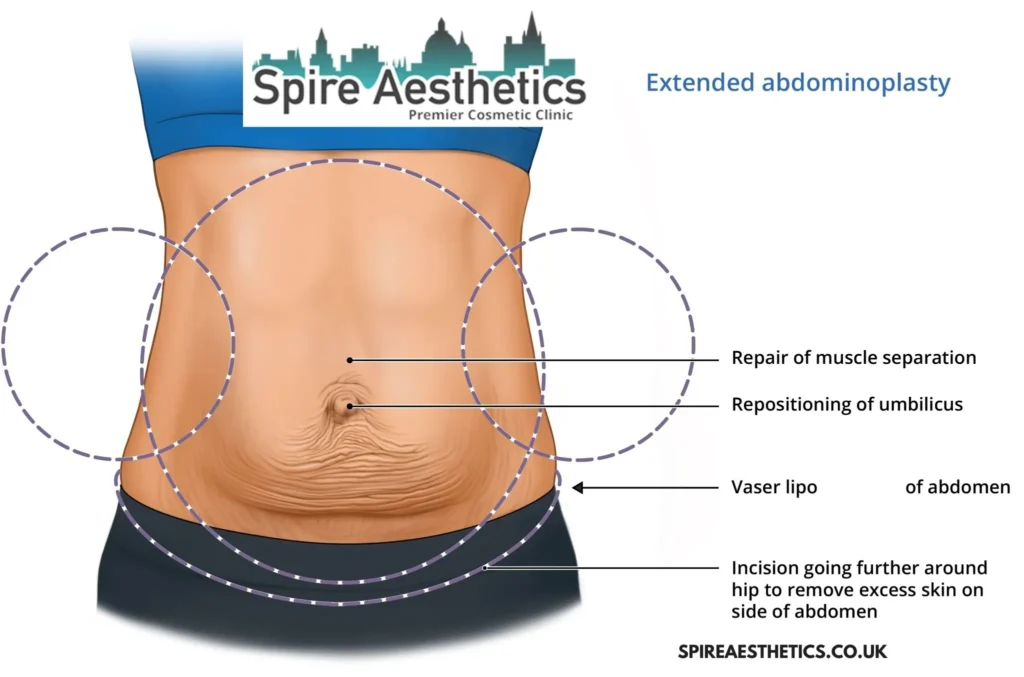 Understanding Loose Skin After Gastric Band Blackburn Surgery and HIFU Treatment