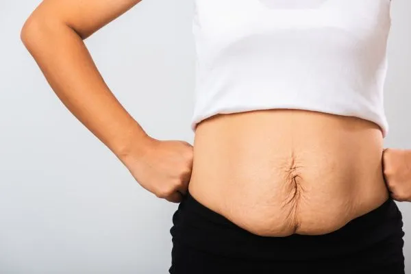 Image of a woman's stomach after weight loss with sagging skin following a gastric band Blackburn