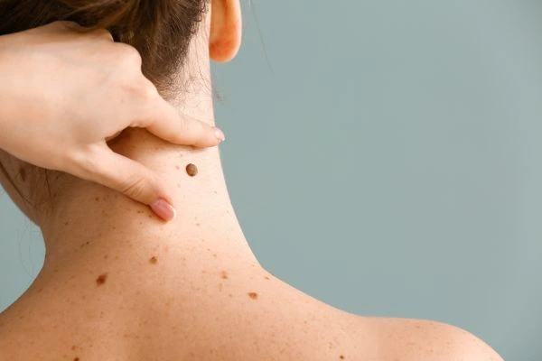 skin blemish removal Blackburn treatment