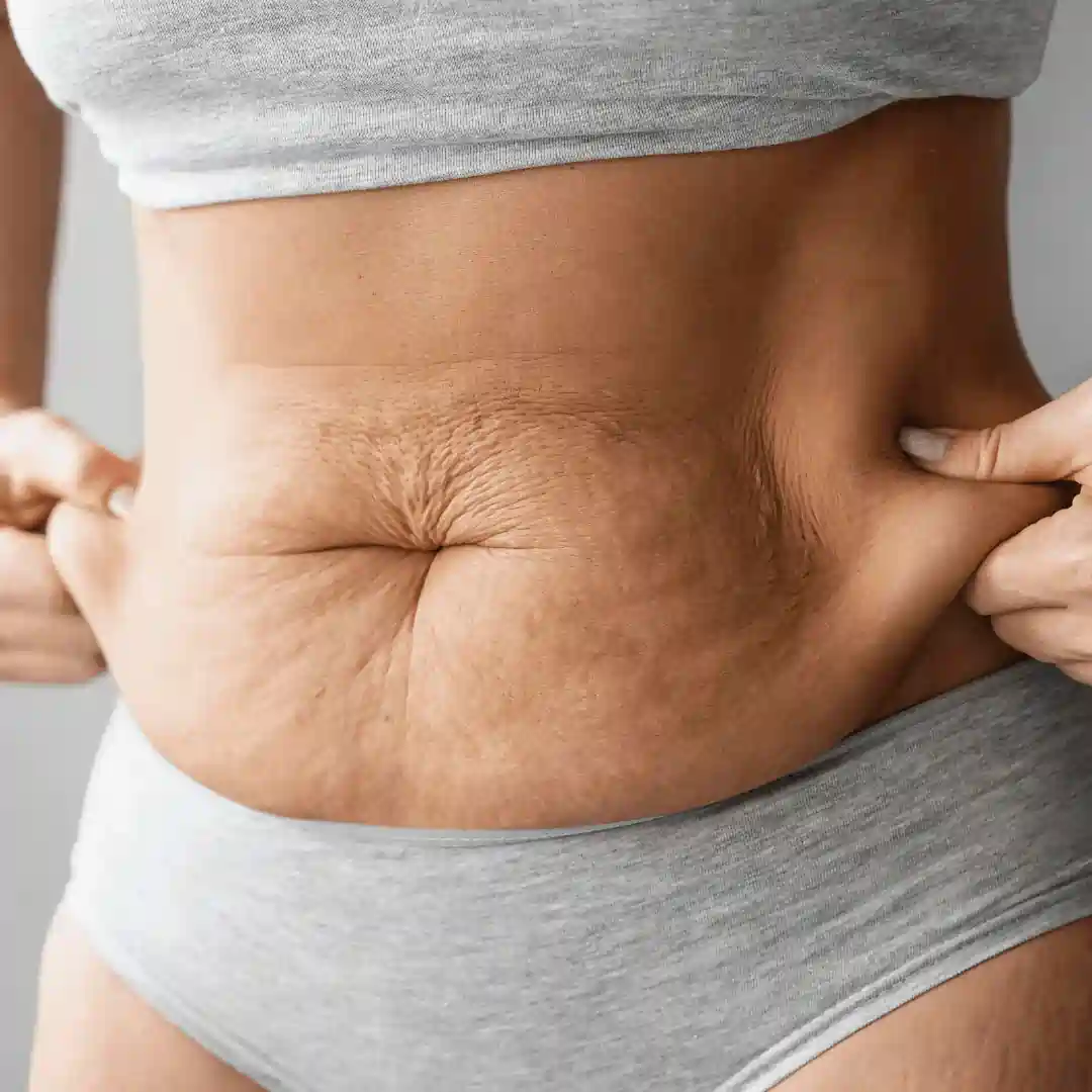 Is It Normal to Have Loose Skin After Pregnancy Blackburn?