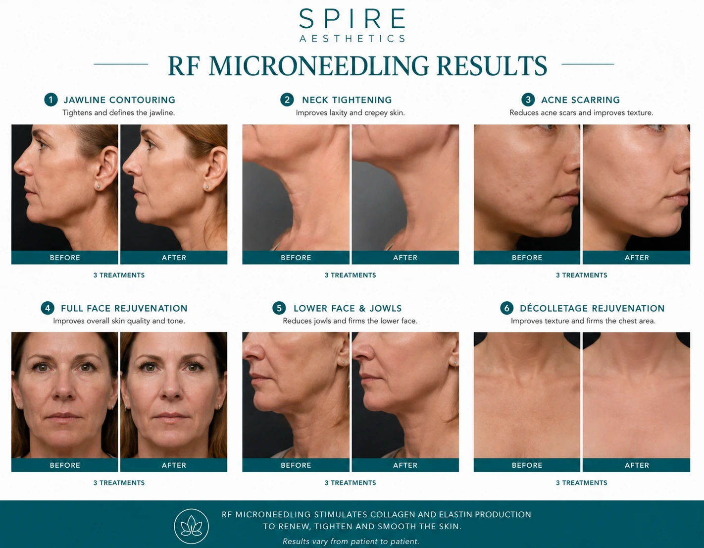 RF Microneedling Skin tightening Blackburn results