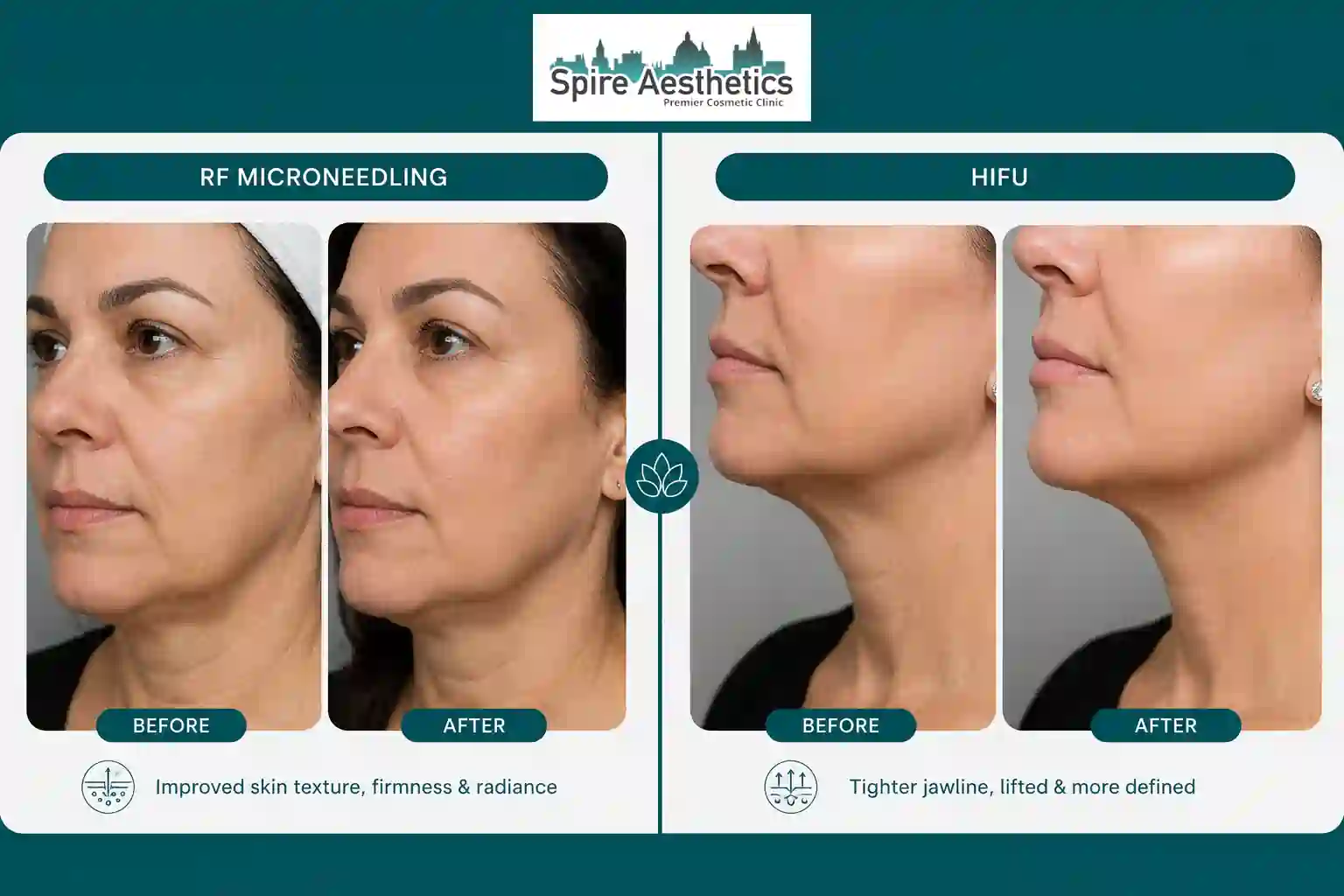 Can RF Microneedling and HIFU Be Combined Blackburn?