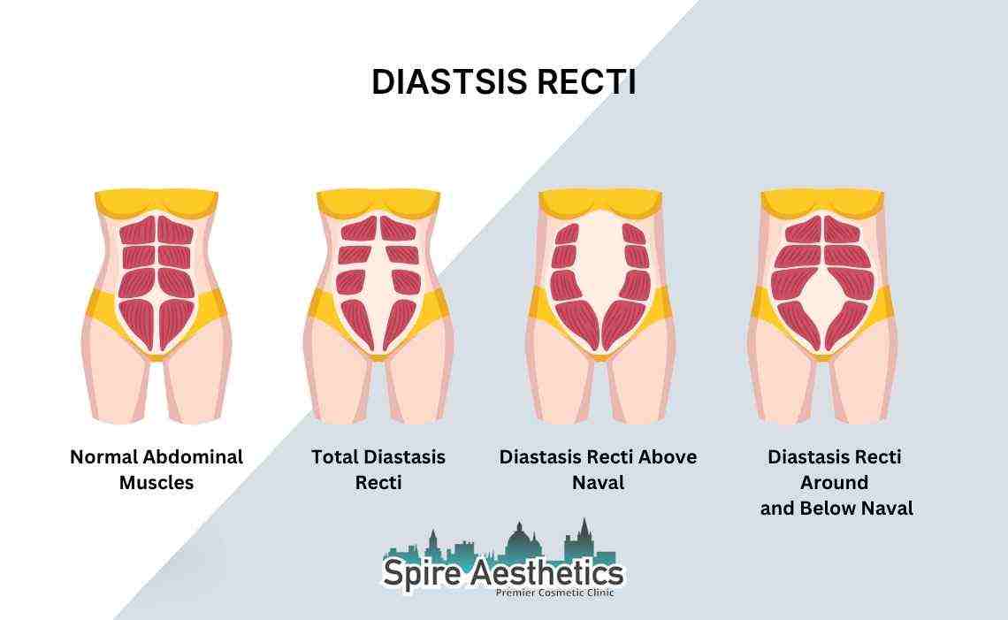 Is Non-Surgical Diastasis Recti Treatment Right for You? Common Concerns Answered Blackburn